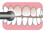・歯のクリーニング・自宅dネオ使用方法の説明