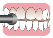 歯のクリーニング、歯垢、歯石、着の除去